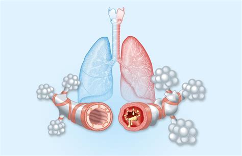 Tezepelumab Reduces Mucus Plugging In Patients With Asthma Latest