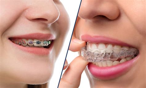 Invisalign Vs Metal Braces At London Dental Smiles We Will Help You