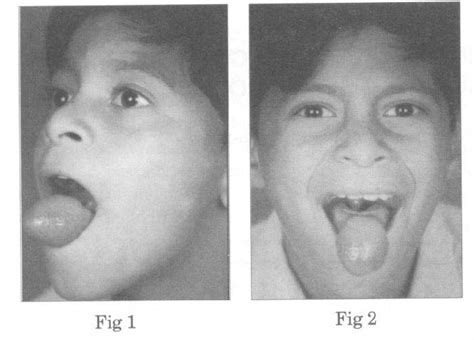 Management Of An Extraordinary Large Mucocele Of The Tongue With