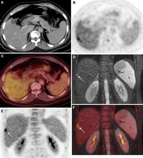 Liver Metastasis From Colorectal Cancer Without Ct Correlate Axial