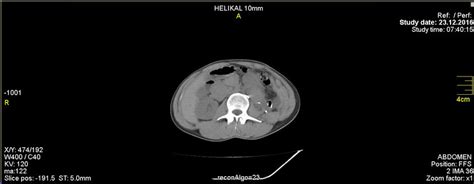Thoracoabdominal Computed Tomography Before Discharge Download