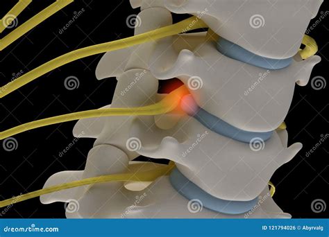 Anatomically Accurate3d Image Of Cervical Spine With Prolapse Of Stock