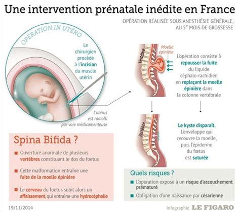 Spina Bifida Un Foetus Opéré Dans Le Ventre De Sa Mère