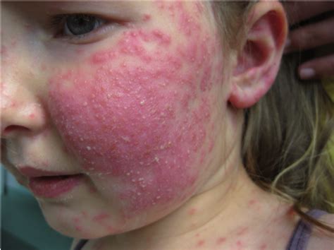 Case 1 Acute Inflammation With Pustules On The Face Download