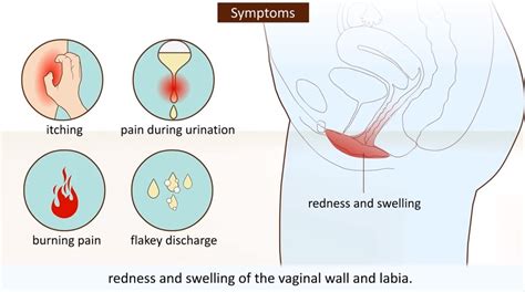 Vaginal Yeast Infection What Is It And How To Avoid It