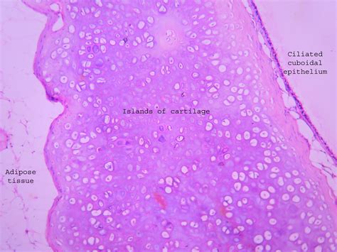 Dermoid Cyst Ovary Histopathologyguru
