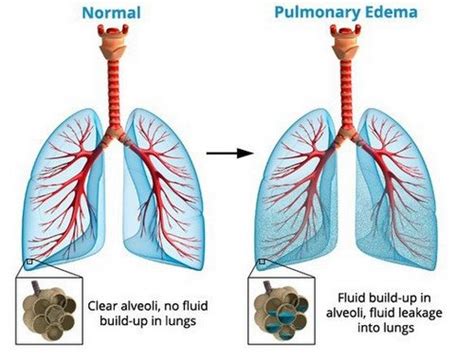 Fluid In Lungs Causes Symptoms And Treatment Updated In 2022