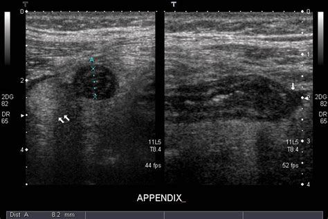 Appendix Appearance On Ultrasound Radrounds Radiology Network
