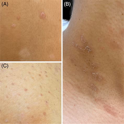 Erythematous Scaly Papules And Plaques In A Guttate Psoriasis Gp B