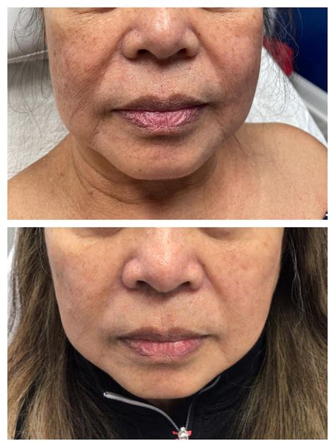 Nasolabial Folds Filler Before And After St Louis Dermatology