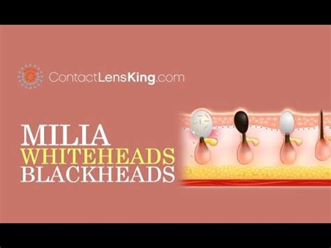 Whitehead And Black Heads Archives Pimple Popping Videos