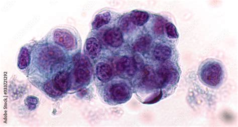 Malignant Fluid Cytology Malignant Cells Of Adenocarcinoma May Spread To Fluid Of Pleural Or