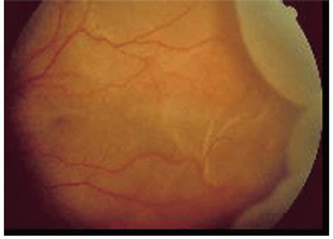 Pathophysiology Of The Retinal Pigmented Epithelium And Choroid Ento Key