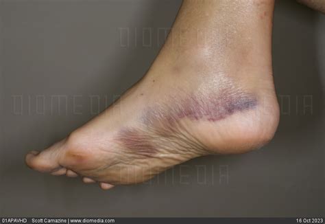 Stock Image Ecchymosis Bruising On The Right Foot Of A 56 Year Old