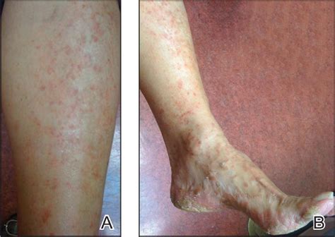 Figure 1 From Pityriasis Lichenoides Chronica Presenting With Bilateral