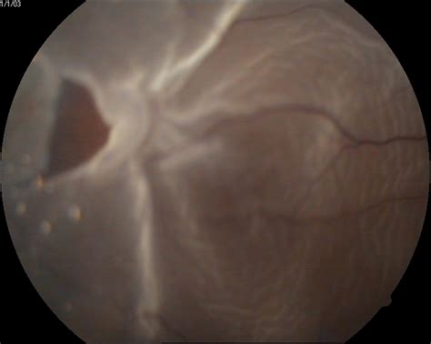 Retinal Tear Retina Image Bank