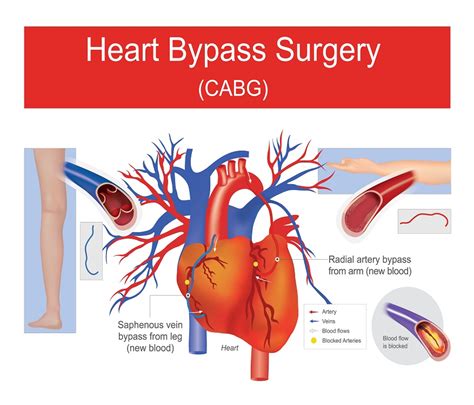 Cabg Coronary Artery Bypass Grafting Srv Hospital