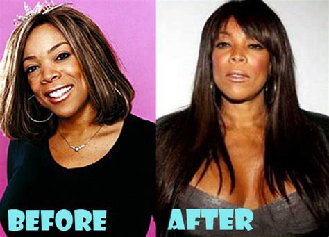 Wendy Williams Plastic Surgery Before And After Pictures Lovely Surgery