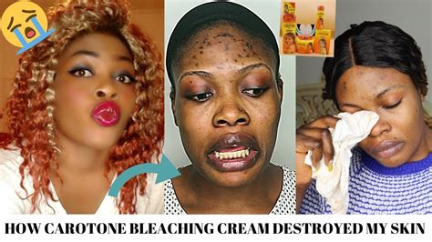 Storytime How Carotone Bleaching Cream Destroyed My Skin😭😭 Youtube