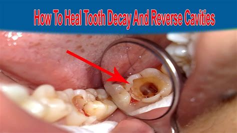 How To Treat Cavities Health And Home Remedies Youtube