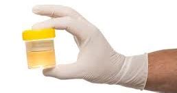 Urine tests are used in a variety of settings, including employment, probationary, court, and even for home purposes. analis laboratorium kesehatan: Sampel Urine