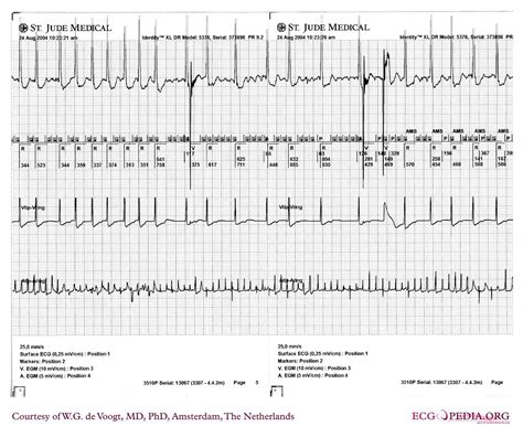 Filedva0935 Ecgpedia