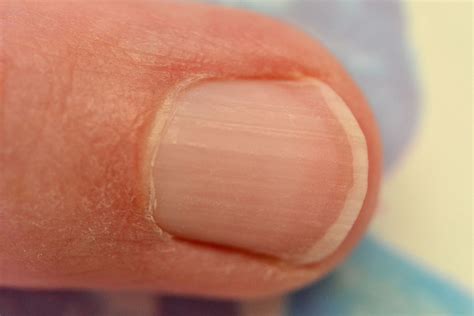 7 Common Nail Problems That Are Actually Symptoms Of Something Bigger