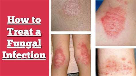 Are Fungal Skin Conditions Contagioussrzphp