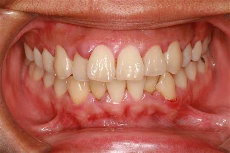 7 Common Signs And Symptoms Of A Tooth Cavity Absolute Dental