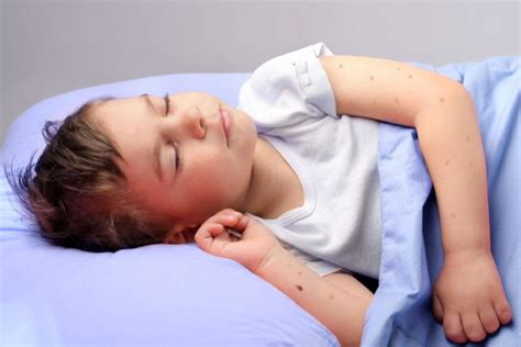 These tiny insects can't fly and typically spread on luggage and clothing. Bed Bug Bites In Kids - Causes And Remedies