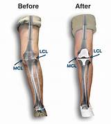 Images of Pain Management After Knee Replacement Surgery