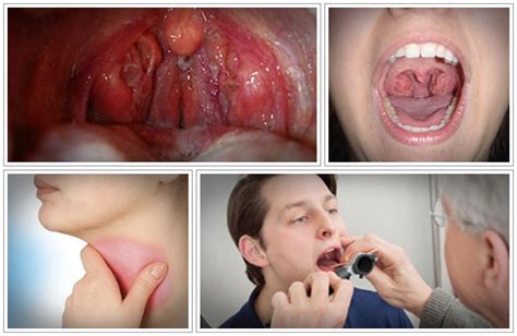 Beat Tonsil Stones Review Introduces How To Get Rid Of Tonsil Stones