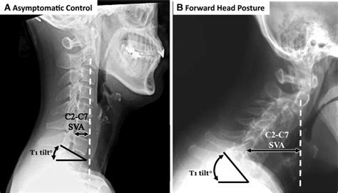 Cervical Sagittal Alignment Measurements In An Asymptomatic Patient A