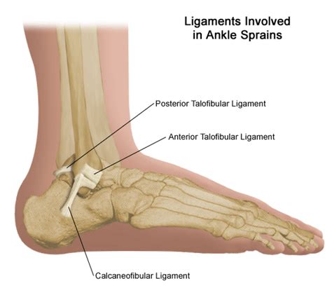 The swelling up of the tendons or ligaments of the bones due to a certain injury or an illness is known as inflammation of ligaments or enthesopathy. Torn Ligament in Ankle: Treatment and Prevention | New ...