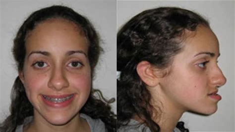 Corrective Jaw Surgery Oral Surgery Procedures