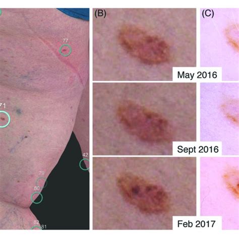 Early Malignant Melanoma In Situ