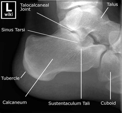 Lateral Calcaneus Xray Medical Radiography Diagnostic Imaging