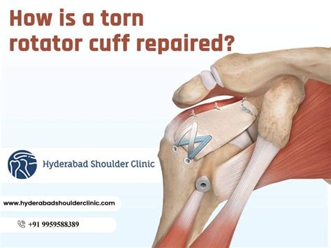 How Is A Torn Rotator Cuff Repaired