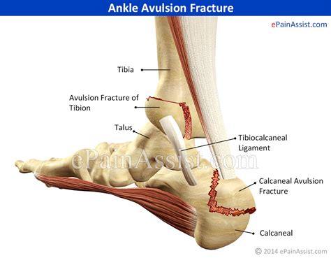 Ankle Avulsion Fracturesymptomscausestreatmentrecovery Timeexercises