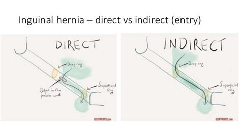 Inguinal And Femoral Hernia