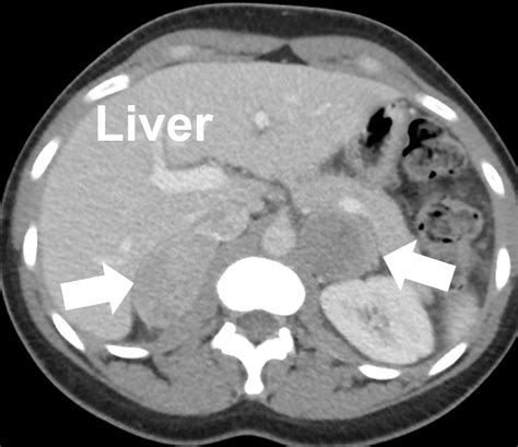 Pheochromocytoma In Children And Pheochromocytomas In Teenagers