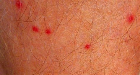 Small Tiny Pinpoint Red Dots On Skin Dont Itch Medityred