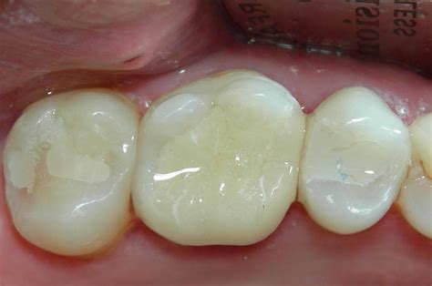 Which Filling Material Is Suitable For Your Teeth ~ Medi Products