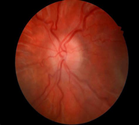 Papilloedema And Optic Disc Swelling Viewpoint