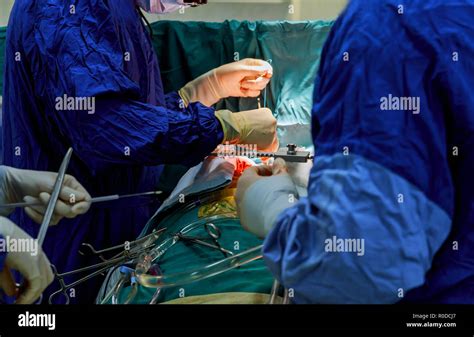 Surgeon With Surgical Instrument During The Open Heart Operation Stock