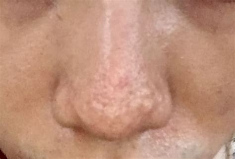 Help Hypertrophic Raised Bumpy Acne Scarring On My Nose Scar