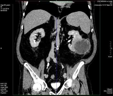 Ct Appearance Of Renal Abscess Eurorad