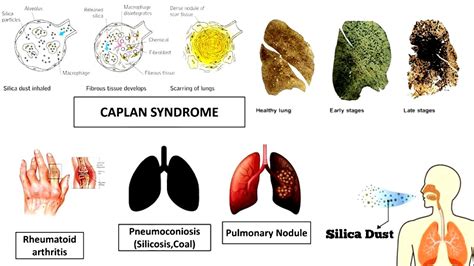 Caplan Syndrome Rheumatoid Pneumoconiosis Causes Symptoms