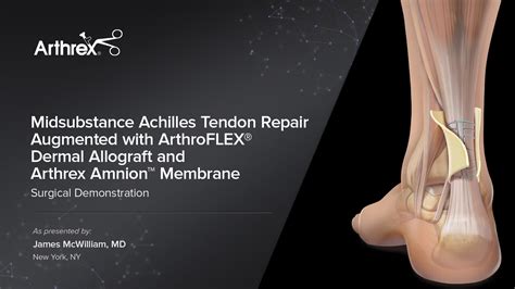 Arthrex Midsubstance Achilles Tendon Repair Augmented With Arthroflex