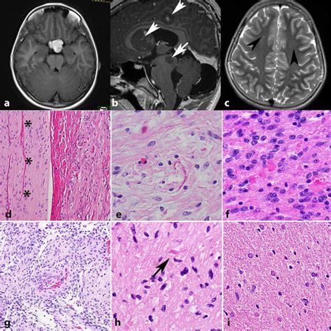 Sporadic Pilocytic Astrocytoma With Anaplasia And Nf1 Pathogenic Gene